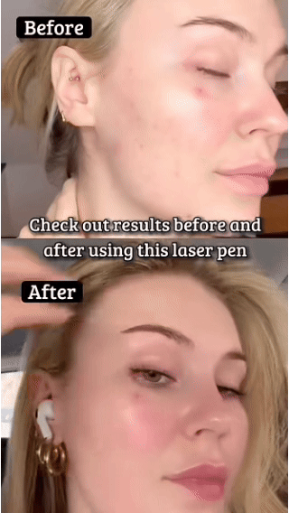 Blue Light Removal Pen Refreshing And Gentle Removal Pen Circulation And Skin Portable Pen