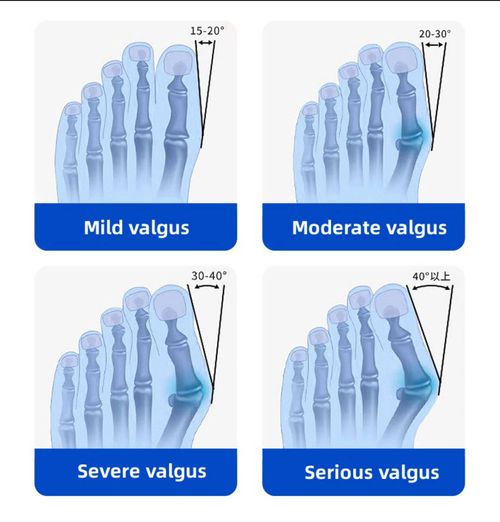 Bunion Relief Splint - Adjustable Toe Straightener with Control Knob for Hallux Valgus & Overlapping Toes, Fits Both Men & Women