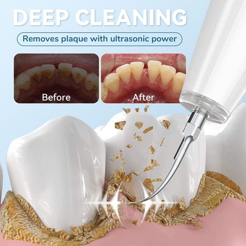 Smart Ultrasonic Water Flosser for Teeth
