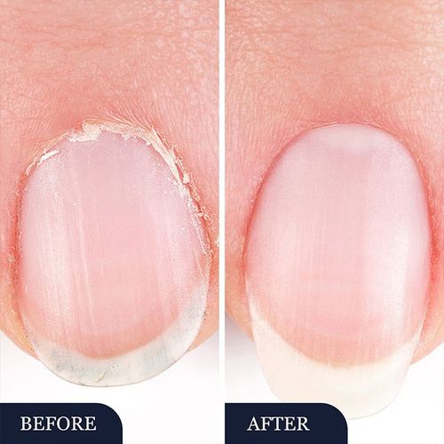 Nail fungus treatment pen for damaged nails
