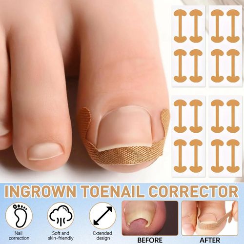 Professional Ingrown Toenail Set with Breathable Ingrown Toenail Strips, Curved Toenails Corrector Patch, Painless File and Lifter Pedicure Tools for Women Man Nail File Lifter Pedicure Tools