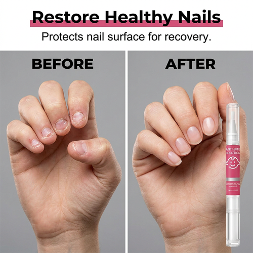 Nail Biting Prevention