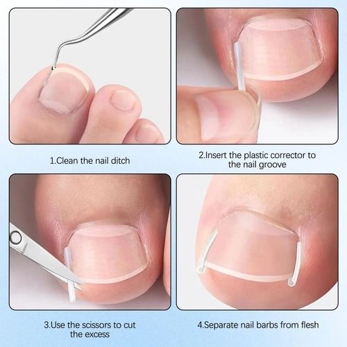 Professional Ingrown Toenail Set with Breathable Ingrown Toenail Strips, Curved Toenails Corrector Patch, Painless File and Lifter Pedicure Tools for Women Man Nail File Lifter Pedicure Tools