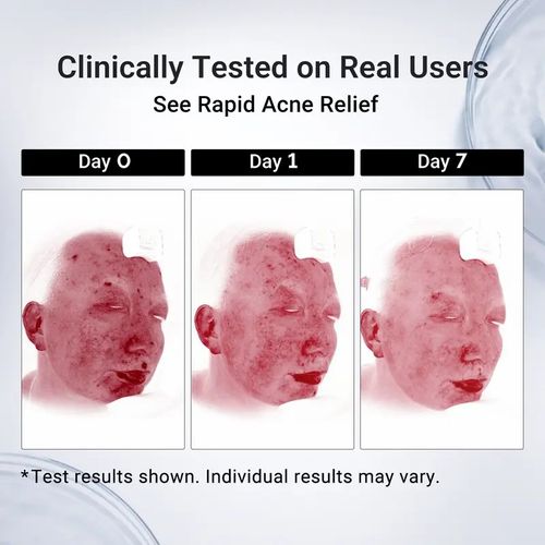 🔥Buy One Get One Free🔥 Acne Treatment Serum ✨,2pack