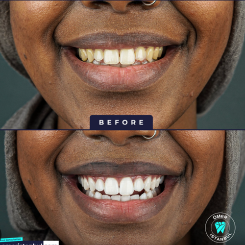 Electric Teeth Cleaner Set