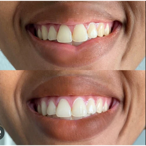 Electric Teeth Cleaner Set