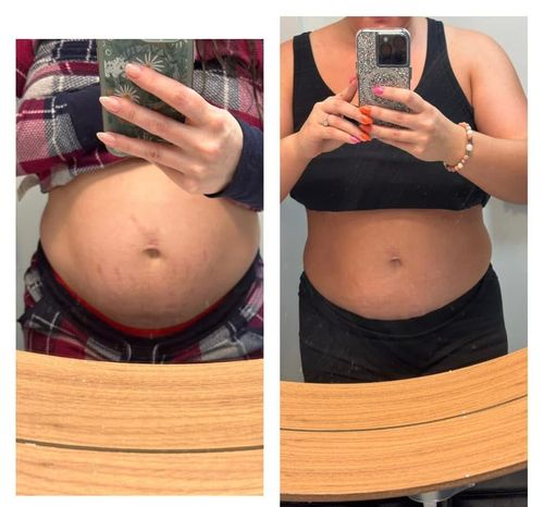 ANTI-STRETCH MARKS SET