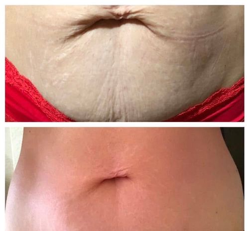 ANTI-STRETCH MARKS SET