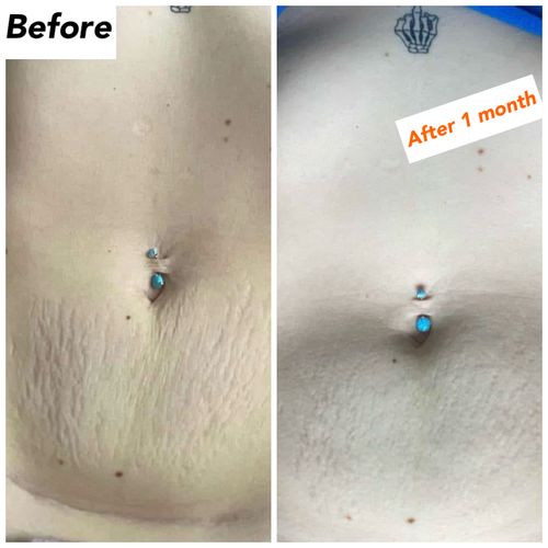 ANTI-STRETCH MARKS SET