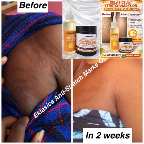 ANTI-STRETCH MARKS SET