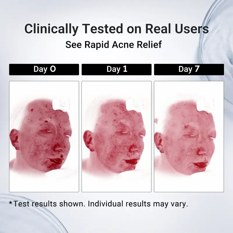 Dr.Leo Drying Lotion | Pimple Treatment & Body Acne Treatment | Visibly Shrinks Pimples in 24 Hours & Helps Fade Acne Marks in 7 Days | With 1.8% Encapsulated Salicylic Acid, 4% Niacinamide & 10% Sulfur (20ml)