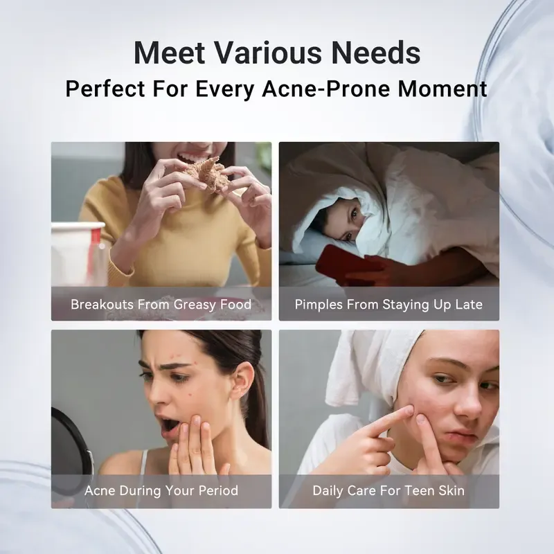 Dr.Leo Drying Lotion | Pimple Treatment & Body Acne Treatment | Visibly Shrinks Pimples in 24 Hours & Helps Fade Acne Marks in 7 Days | With 1.8% Encapsulated Salicylic Acid, 4% Niacinamide & 10% Sulfur (20ml)