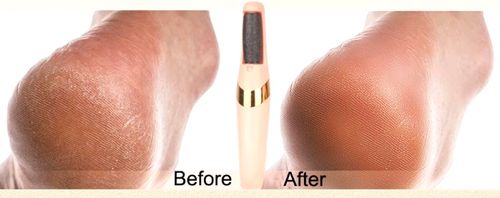 Electric Callus Remover | Rechargeable & Waterproof Pedicure Tool