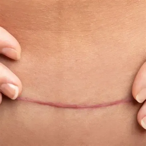 Parche de silicone e cicatrizes auto adesivas