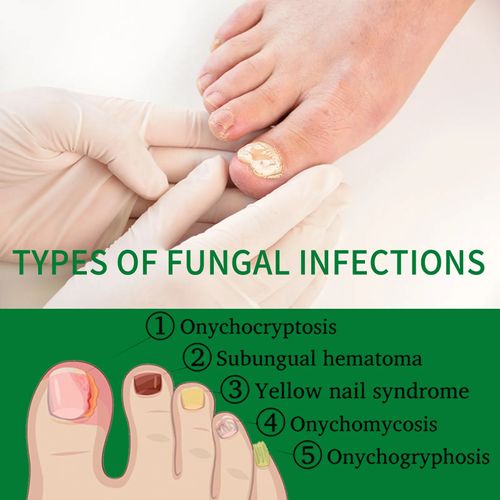 Ginger Nail Care Lotion Repair Hand And Foot Moisturizing
