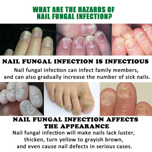 Ginger Nail Care Lotion Repair Hand And Foot Moisturizing