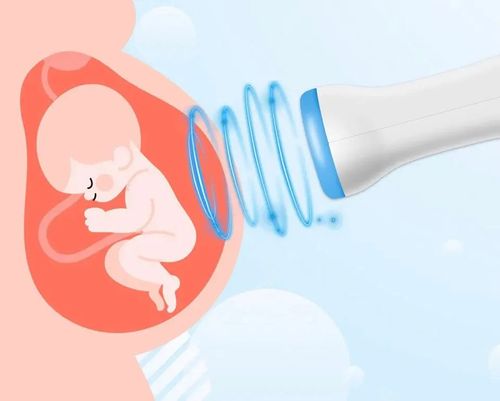 FETAL DOPPLER (BABY WATCHER)