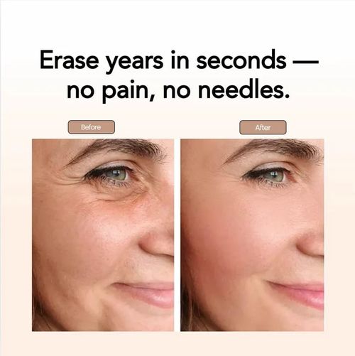 V-Lock Invisible Patches