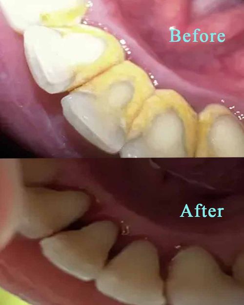 Electric Tooth Stain Remover