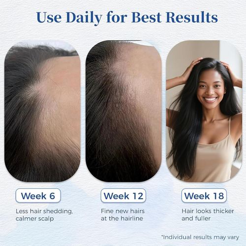 Aparthy's Advanced Hair Growth Roll-on Serum contains saw palmetto, rosemary, and pea extracts to help create thicker, fuller hair. It's refreshing and non-greasy, suitable for both men and women, and effectively prevents hair loss.