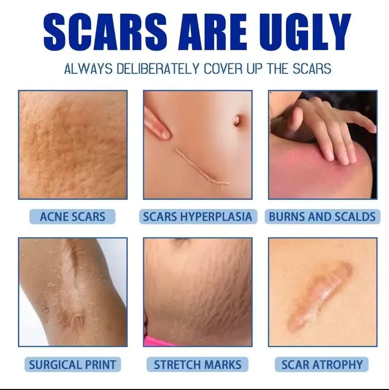 Professional Scar Removal Cream, AdvancedSilicone Skin Repair Gel for Burn,Acne Old Scar Removal Cream for Face & Body | Fades DarkScars
