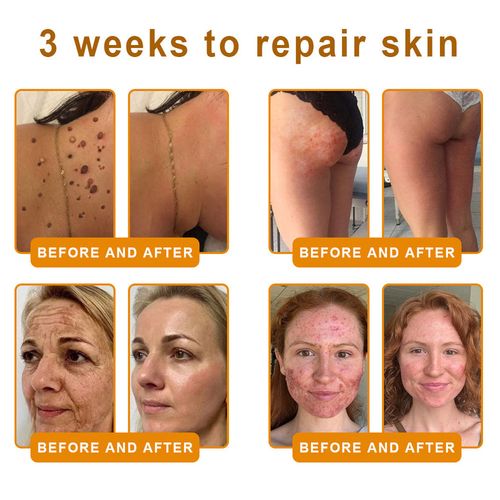 ✨ 𝐁𝐞𝐞 𝐕𝐞𝐧𝐨𝐦 𝐒𝐤𝐢𝐧 𝐑𝐞𝐬𝐭𝐨𝐫𝐚𝐭𝐢𝐨𝐧 𝐂𝐫𝐞𝐚𝐦