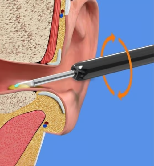 Wi -Fi visible wax elimination spoon-1080P HD load otoscope（BLACK）