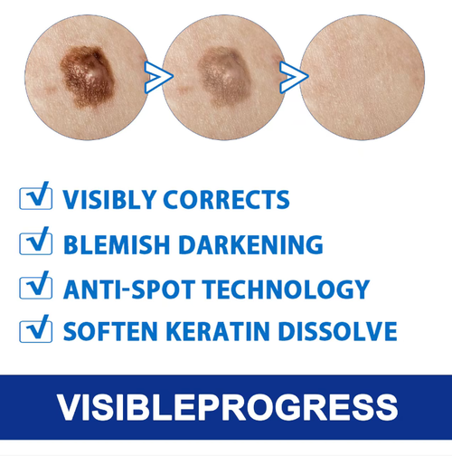 Pomada Plana Filamentosa para Verrugas.  Faça o pedido hoje e você receberá 8 tubos.  Utiliza uma fórmula natural de ervas e é especificamente projetada para tratar crescimentos de pele e verrugas comuns.  Ele pode remover verrugas de forma eficaz sem deixar cicatrizes, prevenir recorrências e cuidar suavemente da pele.  Ele pode facilmente resolver problemas relacionados a verrugas e proporcionar uma experiência de limpeza totalmente nova, abrindo caminho para uma pele bonita e sem verrugas.