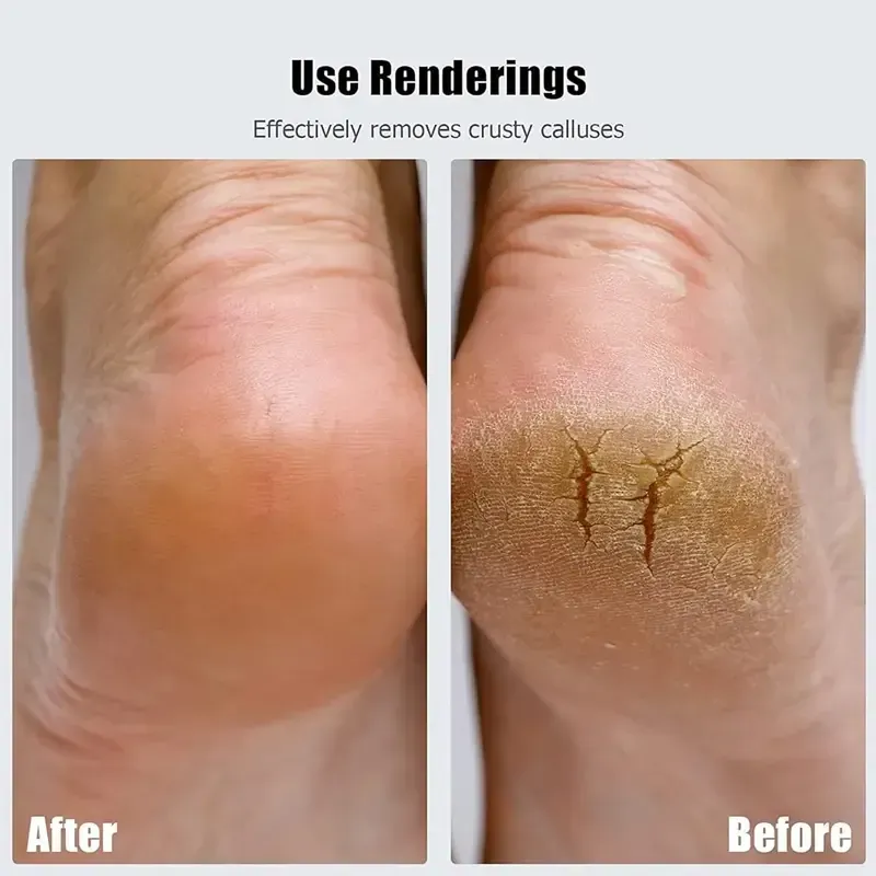 Esta não é uma máquina de lixar os pés, é claramente uma máquina de polir os pés. Quando a pele velha e morta e os calos entram em contacto com ela, todos derretem como flocos de neve em contacto com o sol. Depois de tocar nos meus pés, não consigo deixar de suspirar, são tão macios!