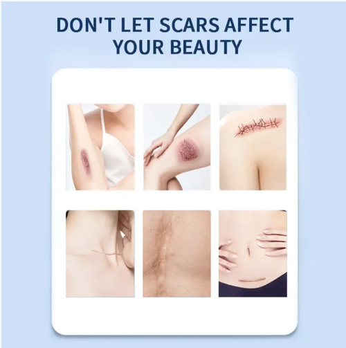 Gel médico para cicatrizes, uma tecnologia de ponta para remodelação de colágeno.  Ele decompõe o colágeno, guia sua disposição e repara a barreira.  Pode eliminar todos os tipos de cicatrizes, queimaduras e marcas de acne.  É de grau médico e suave para uso pós-operatório.  Faça o pedido hoje e adquira 6 tubos!  Cicatrizes novas ficarão macias em 28 dias, e cicatrizes antigas ficarão macias em 3 meses.  Toda a pigmentação vai desaparecer, permitindo que você recupere a pele lisa!