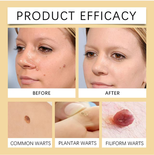 Creme para Verrugas com Veneno de Abelha: Uma fórmula natural que elimina efetivamente várias verrugas.  Ele penetra e elimina suavemente a hiperplasia, repara a pele e evita o uso de laser e crioterapia.  Ele permite que você consiga uma pele lisa em casa.  Faça o pedido hoje e receba 3 caixas!  Limpe todas as verrugas do rosto, mãos e áreas íntimas, evitando recorrências.  Diga adeus a todas as verrugas e recupere uma pele fresca e confiante!