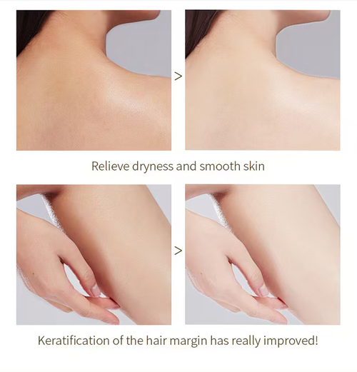 Faça o pedido hoje e você receberá 5 frascos de Gel Esfoliante de Enzimas Laranjas e Gel de Limpeza Profunda para Remoção de Pontos Pretos.  Ele contém enzimas suaves que podem decompor células mortas da pele.  Pode ser aplicado na pele facial e desentupe os poros de forma eficaz, clareia a pigmentação e nutre a pele.  Após o uso, a pele ficará macia e não esticada, e naturalmente terá uma aparência brilhante mesmo sem maquiagem.