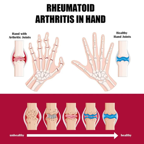 Faça o pedido hoje e você receberá 3 caixas do poderoso creme de tratamento de articulações e ossos do ingrediente natural Venom Filtrate, totalizando 150g.  Cada caixa contém 50g do produto.  Ele pode penetrar a pele e proteger as articulações, aliviando rigidez e dor.  É adequado para todas as articulações e tem uma textura refrescante, sem nenhuma oleosidade.  Para o cuidado diário das articulações de todas as pessoas, este é um produto conveniente e excelente.