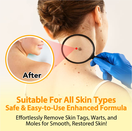 Faça o pedido hoje e você receberá 3 frascos do Tag Resede Bee Venom Direct to Site Rapid and Safe Painless Removal Spray.  Esse spray é formulado com extratos naturais de plantas e pode bloquear suavemente o fornecimento de nutrientes para as verrugas, fazendo com que elas caiam sem dor e sem deixar marcas.  O spray foi projetado para ser conveniente e preciso, e pode reparar imperfeições da pele de forma eficaz.  Até peles sensíveis podem ser usadas com confiança.