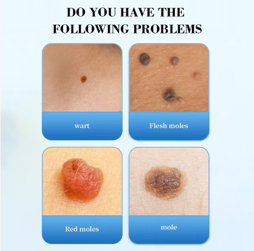 Faça o pedido hoje e você receberá 3 frascos de essência sérica 100% natural à base de plantas, desenvolvida por um médico da pele, para remover pintas e verrugas.  Utiliza uma fórmula suave à base de plantas e não causa irritação.  O design preciso da cabeça do pincel garante que não contaminará a pele saudável.  Ele pode facilmente lidar com problemas como pintas, verrugas e calos, oferecendo serviços convenientes de reparo em casa para restaurar a pele lisa e bonita.