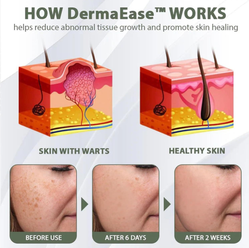 Faça seu pedido hoje e você receberá 3 frascos grandes de gel natural para remover verrugas,pintas e manchas desbotadas: abacate + essências de ervas.  Aplique suavemente por 2-3 semanas, e as verrugas vão secar e cair, enquanto as pintas vão desaparecer a ponto de ficarem invisíveis.  Até peles sensíveis podem usar isso!  Estoque o suficiente para eliminar todas as verrugas. pintas.  manchas, e se sente mais confiante ao mostrar seu rosto natural.  A ação está em alta demanda, então pegue logo!