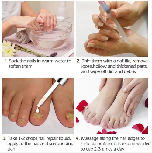 Se você fizer um pedido hoje, receberá 6 unidades, o que é um tratamento completo.  A caneta antifúngica contém 25% de ácido não decenóico e penetra com precisão para inibir fungos.  O design em formato de caneta é portátil e à prova de vazamentos, suave e não irritante.  Pode melhorar os pés rachados e o pé de atleta.  Um cuidado diário de 2 minutos é tudo que você precisa!