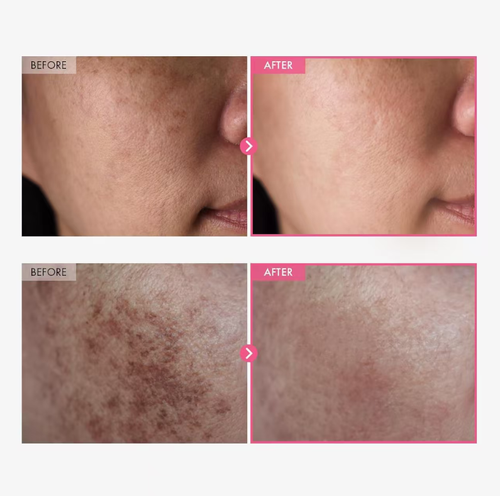 Cicatrizes de acne estão te incomodando?  Este creme de extrato de ursinho pode atenuar cicatrizes e acne ao mesmo tempo.  Possui uma textura de gel à base de água, transparente e não oleosa, proporcionando hidratação e controle da oleosidade.  Também pode desbotar manchas solares e marcas de acne.  Peça hoje e adquira 5 garrafas.  Cada garrafa é tarifada pelo preço de uma xícara de chá com leite.  Pode ser usado para tratamento de emergência pós-sol e manutenção diária.