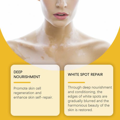 Não perca a oferta exclusiva de hoje! Pegue 3 frascos do Bee Venom Vitiligo Sooing Repair Cream de uma vez. Os ingredientes principais do veneno de abelha nutrem profundamente a base da pele, promovem a regeneração celular e aprimoram a capacidade de autorreparação. Ele age suavemente nas áreas afetadas, desfocando gradualmente as bordas das manchas e uniformizando a pele na pele, sem efeitos colaterais e proporcionando tranquilidade. É um item indispensável para cuidados com a pele.