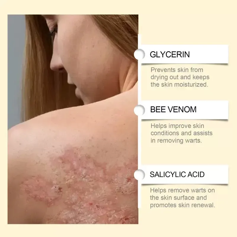 Hoje,estamos lançando 3 frascos do Bee Venom Care Cream.Cada tubo pode aliviar a secura,vermelhidão e aspereza!Extrato de consolda com veneno de abelha,ele repara e retém a umidade,amolece a pele e é absorvido instantaneamente com uma textura parecida com manteiga.  Em 15 minutos, a sensação de ardor diminui, a vermelhidão e os vasos sanguíneos desaparecem, e os poros ficam menores.  Os ventiladores antigos elogiam como sem recorrência de secura e coceira,e as juntas estão lisas e escorregadias!