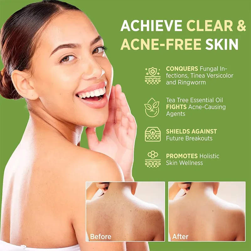 Óleo de Chá Óleo Antifúngico O Salvador para Peles Propensas a Acne.  Peça hoje e pegue 3 garrafas por apenas $3.  Ele contém óleo de árvore do chá australiano, controlando efetivamente o óleo e tratando a acne, melhorando a acne nas costas.  A fórmula à base de plantas é suave e hidratante, permitindo que você consiga uma pele refrescante e sem acne com facilidade.  Aproveite a oferta e pegue agora!