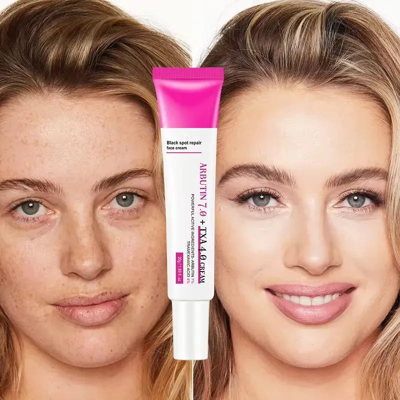 O DOLANJN Facial Cream ataca diretamente a causa raiz da melanina, reduzindo e desbotando manchas: manchas solares, manchas opacas e cicatrizes de acne podem ser clareadas, tornando o rosto gradualmente mais liso e claro.  Sua textura refrescante é adequada para tipos de pele oleosa.  Use de manhã e à noite, cobrindo o ciclo de reparo, e diga adeus a imperfeições e falhas.  Peça hoje e pegue 4 garrafas.