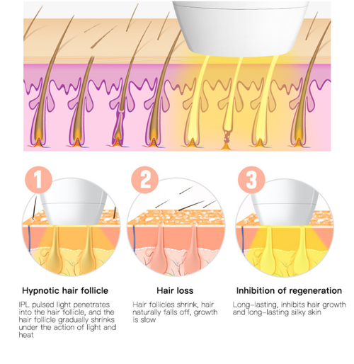 Dispositivo de depilação a laser de grau clínico remove pelos da raiz e proporciona suavidade duradoura.  O laser mira precisamente nas raízes dos folículos capilares.  Modo duplo + múltiplas engrenagens são compatíveis para todo o corpo, alcançando uma suavidade duradoura.  Compacto e fácil de operar, com óculos de proteção.  Em casa, você pode alcançar o nível de remoção profissional de pelos da clínica e desfrutar de uma pele linda durante toda a estação!