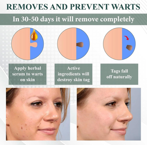 Faça seu pedido hoje e você receberá 3 frascos grandes de gel natural para remover verrugas,pintas e manchas desbotadas: abacate + essências de ervas.  Aplique suavemente por 2-3 semanas, e as verrugas vão secar e cair, enquanto as pintas vão desaparecer a ponto de ficarem invisíveis.  Até peles sensíveis podem usar isso!  Estoque o suficiente para eliminar todas as verrugas. pintas.  manchas, e se sente mais confiante ao mostrar seu rosto natural.  A ação está em alta demanda, então pegue logo!