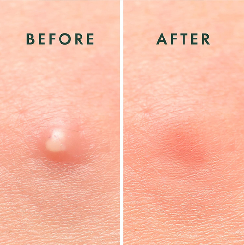 Adesivos poderosos para remover acne.  Se você fizer um pedido hoje, receberá um total de duas caixas de produtos, com 96 adesivos cada!  Essa tecnologia de hidrogel pode absorver secreções de acne, isolar contaminantes, criar um efeito fosco transparente e não entupir os cosméticos.  É adequado para peles sensíveis.  Acne vermelha e inchada, acne de ponto branco – um adesivo serve!  Elimine rapidamente a acne e restaure a condição lisa e bonita da sua pele.