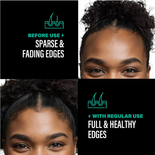 Faça seu pedido hoje e você receberá 2 frascos do Óleo Nutritivo de Batana para Cabelo Hidratante e Óleo Liso para Cabelos Hidratantes e Lisos.  Ele pode controlar efetivamente a secreção de óleo e nutrir o cabelo, proporcionando um efeito duplo: as raízes do cabelo ficam firmes em 8 horas e os espaços na linha do cabelo quase imperceptíveis.  Para os preguiçosos, é uma escolha ideal para emergência ou cuidados profundos.  Rápido, faça seu pedido agora!