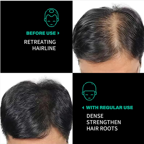 Faça seu pedido hoje e você receberá 2 frascos do Óleo Nutritivo de Batana para Cabelo Hidratante e Óleo Liso para Cabelos Hidratantes e Lisos.  Ele pode controlar efetivamente a secreção de óleo e nutrir o cabelo, proporcionando um efeito duplo: as raízes do cabelo ficam firmes em 8 horas e os espaços na linha do cabelo quase imperceptíveis.  Para os preguiçosos, é uma escolha ideal para emergência ou cuidados profundos.  Rápido, faça seu pedido agora!