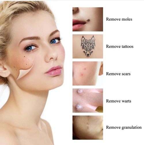 Faça tratamentos leves de beleza em casa facilmente!  Esta caneta inteligente para remoção de pintas possui 5 configurações ajustáveis.  As agulhas finas são controladas com precisão, Pode ser usado para remover sinais, manchas desbotadas e clarear marcas de acne.  Até iniciantes conseguem dominá-lo.  Você pode cuidar de si mesma em casa ou durante as viagens, economizando dinheiro e tempo no salão de beleza.  Uma caneta resolve pequenas falhas, e o efeito delicado é alcançado sem esforço!