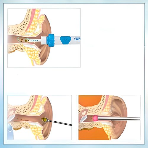 Electric ear scoops, ear cleaners, children and adults' ear cleaning devices
