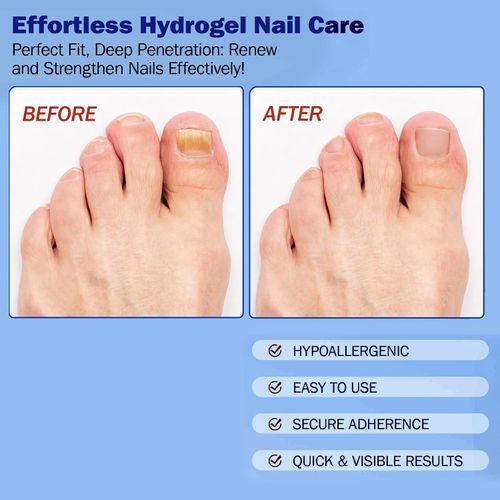 Fungal Nail Patches for Toenails, 21 Count - Nail Repair Patches with 8-Hour Adhesion, for Discolored & Damaged Toenails Care, Overnight Renewal for Men & Women